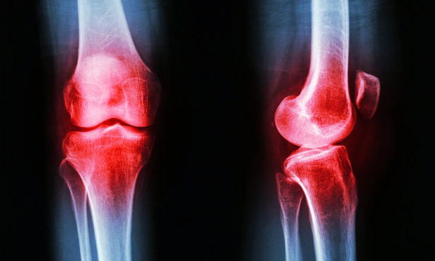 bigstock-osteoarthritis-knee-78730328